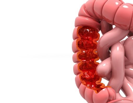 Obat Anti Radang, Efektifkah Atasi Kanker Usus Besar?
