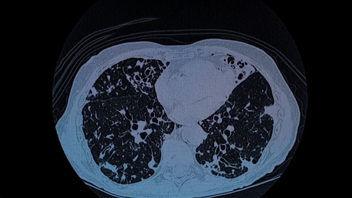Faktor yang Meningkatkan Risiko Bronkiektasis