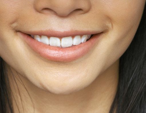 Lapisi Gigi, Dapatkan Senyum Indah