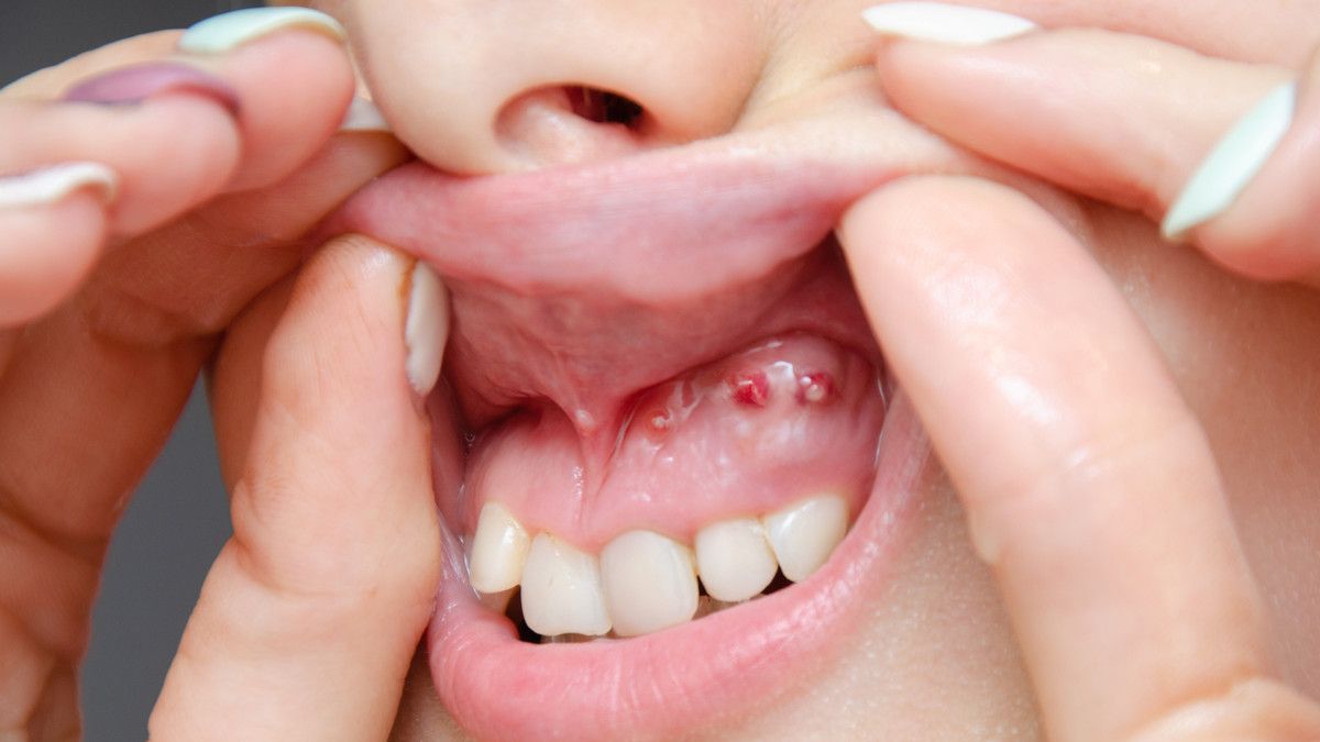 obat sakit gigi gusi bengkak bernanah 4