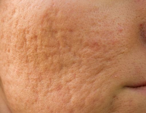 13 Cara Mengecilkan Pori-Pori Kulit yang Efektif