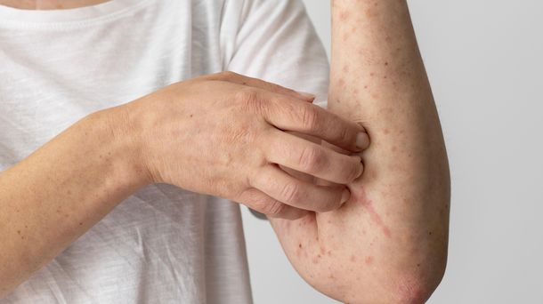 Tanda-Tanda Penyakit Campak Mulai Sembuh dan Masa Pemulihannya