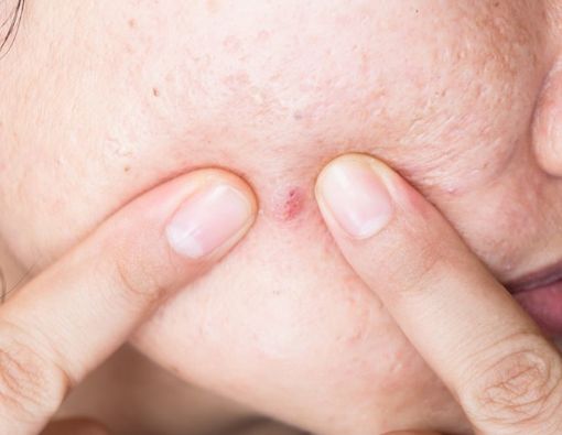 Jangan Abai, Ini Komplikasi Jerawat Jika Tidak Ditangani Tuntas