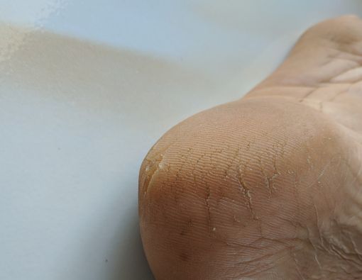 Cara Alami Mengatasi Kaki Pecah-Pecah