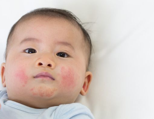 Ada Jerawat pada Bayi, Ini Penyebab dan Cara Mengatasinya