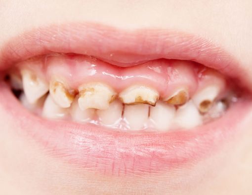 Mengenali Tanda Bullying pada Anak dari Giginya