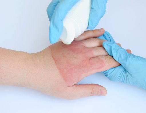 Mitos Seputar Penanganan Luka Bakar Ringan