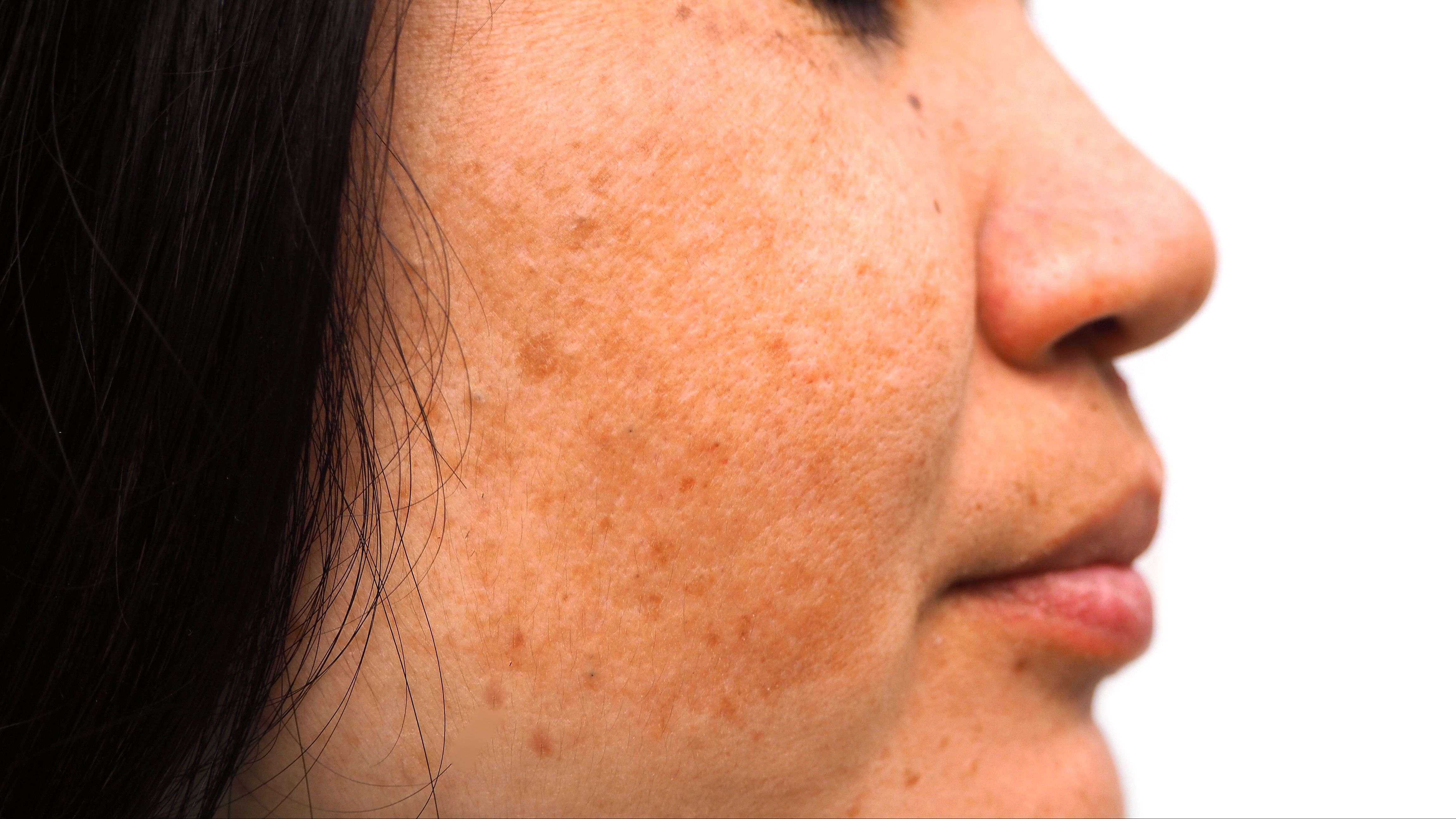 Kenali Gejala Melasma pada Wajah