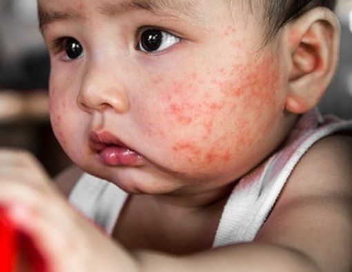 Kenali Ruam Merah pada Wajah Si Kecil