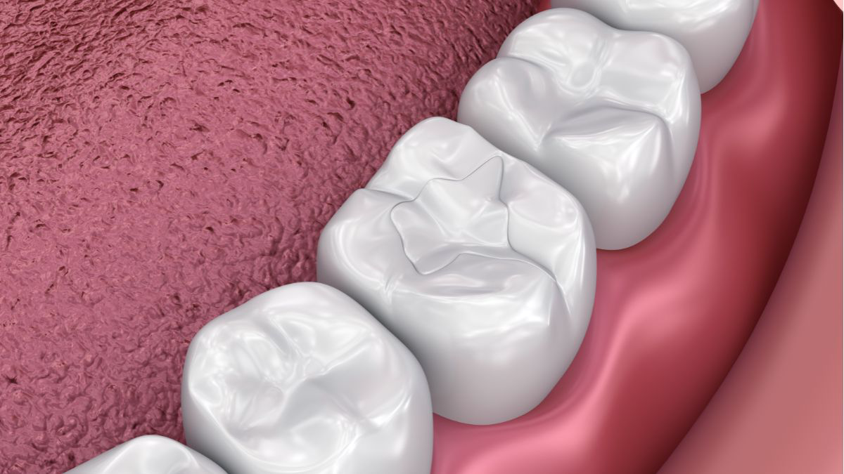 Cegah Karies Gigi Sejak Dini dengan Fissure Sealant