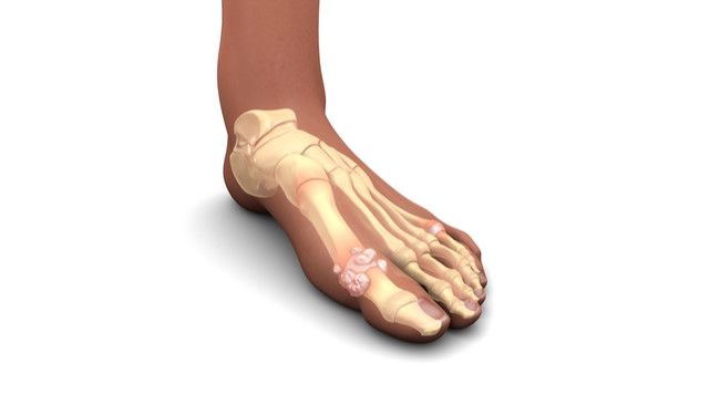 Mengenal Gejala Asam Urat Berdasar Tingkat Keparahan