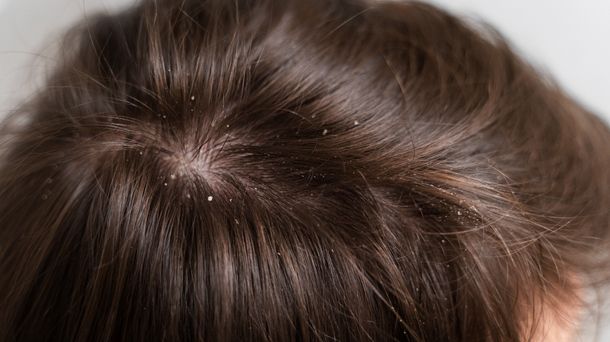 Cara Mengatasi Ketombe Kering agar Tidak Mudah Kambuh