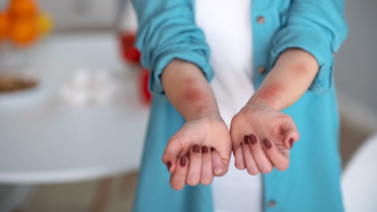 8 Pantangan Biduran agar Tidak Kambuh