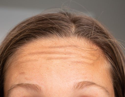 Cara Mencegah dan Mengatasi Garis Kerutan di Dahi