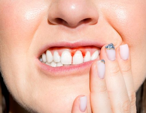 Berbagai Faktor yang Meningkatkan Risiko Periodontitis