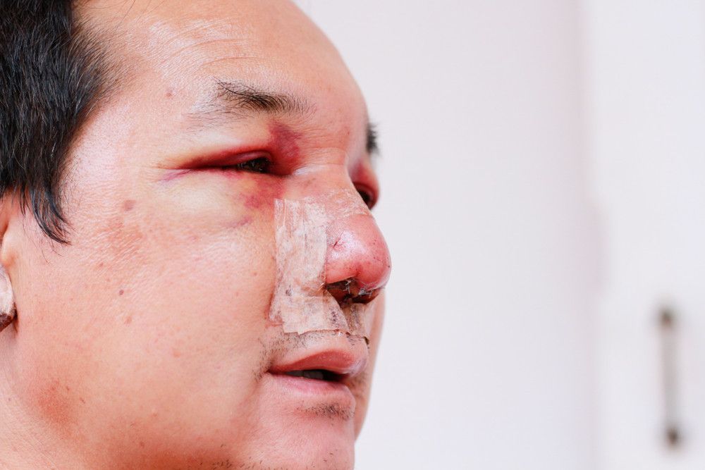 Berapa Lama Luka Akibat Operasi Plastik Bisa Pulih?