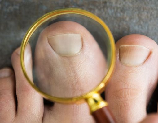 Sering Menimbulkan Nyeri, Ini Ciri-Ciri Cantengan pada Kuku