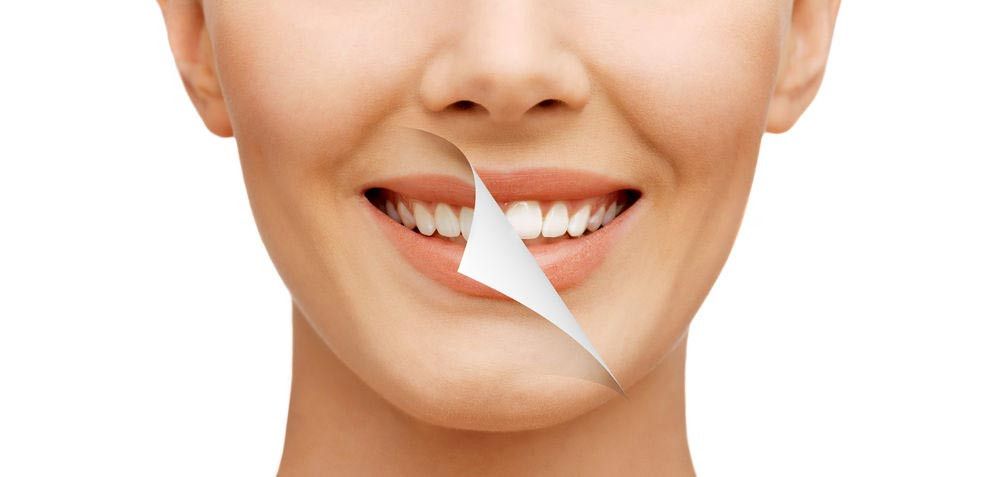 Cara Memutihkan Gigi Tanpa Efek Samping