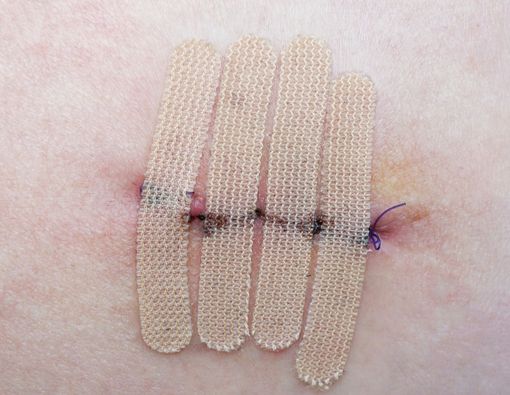 Apa Saja Dampak Rokok pada Penyembuhan Luka Operasi?