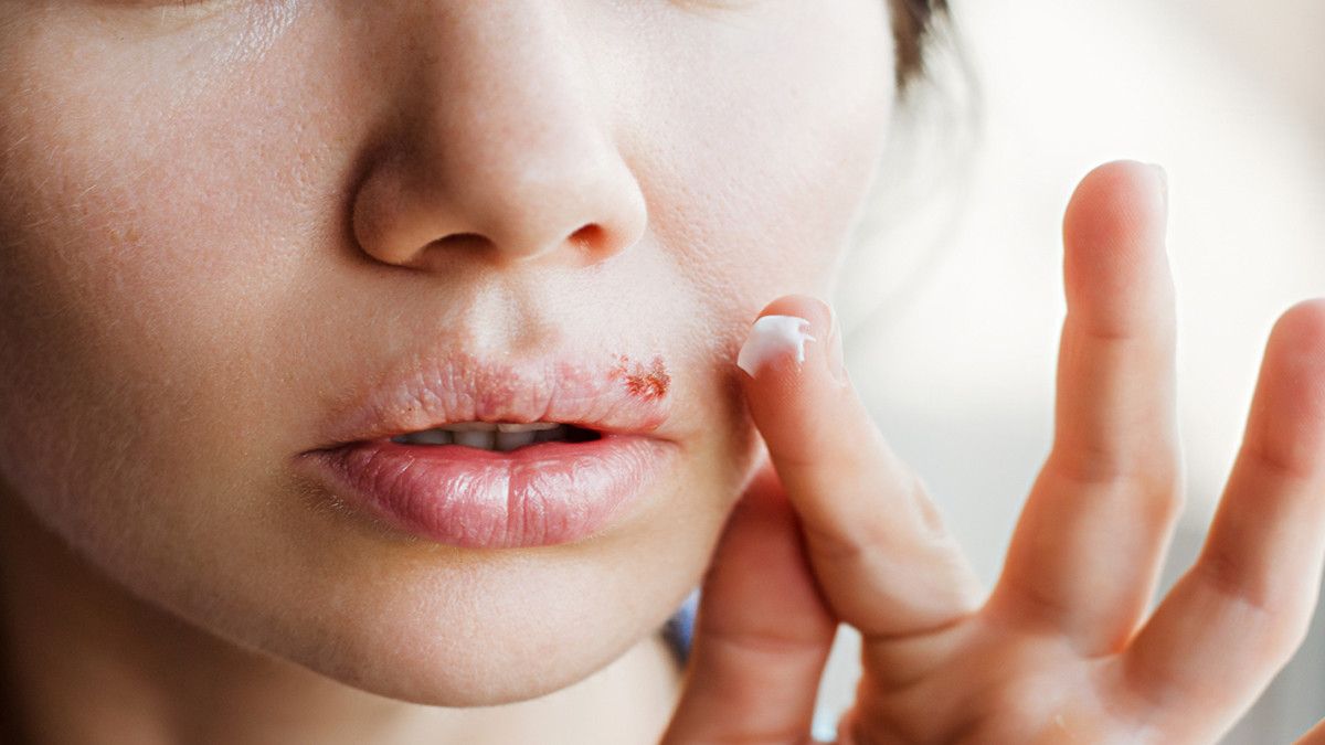 Herpes Mulut, Tidak Hanya Terjadi di Alat Kelamin