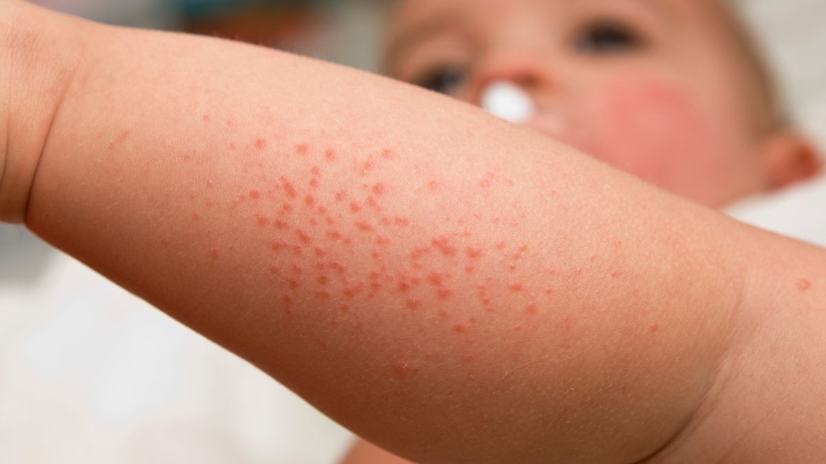 gejala-henoch-schonlein-purpura-pada-anak-klikdokter