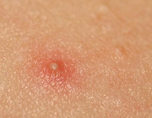 Ada Bisul di Anus (Abses Perianal), Apakah Seks Anal Penyebabnya?