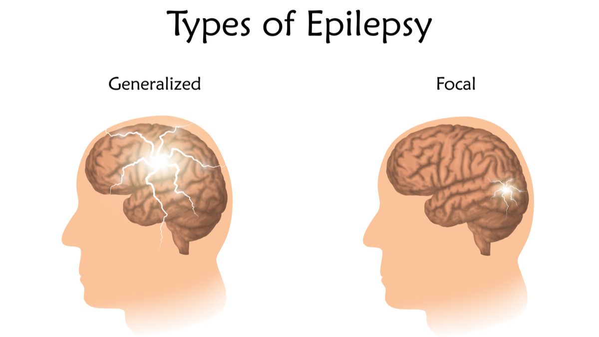 Sering Epilepsi Menandakan Gejala Kanker Otak?