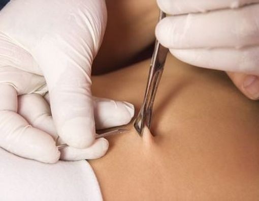 Risiko Tindik di Kemaluan