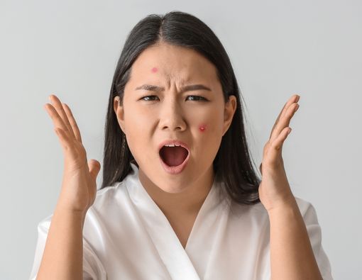 15 Obat Jerawat Paling Ampuh di Apotek 