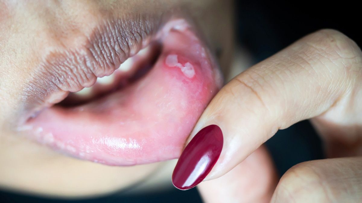 Heran, Mengapa Sariawan Muncul Setelah Cabut Gigi?