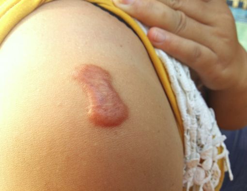 Penyebab Munculnya Keloid di Kulit