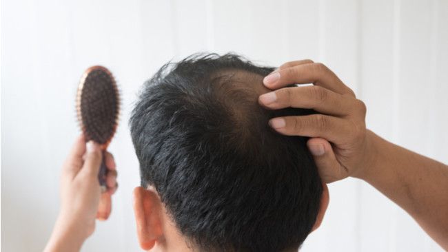 Rambut Rontok Berhubungan dengan Testosteron?