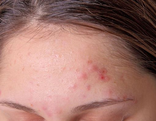 Sudah Tua Kok Masih Jerawatan?