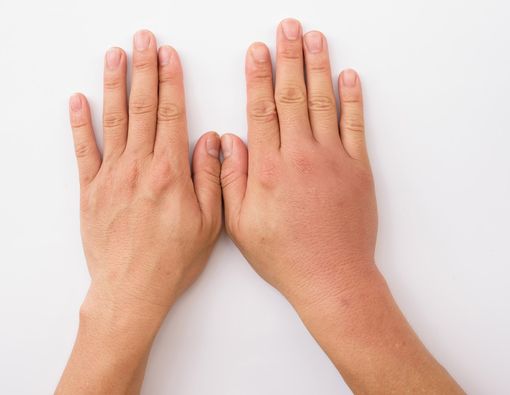 Jari Tangan Bengkak, Bisa Jadi 5 Hal Ini Penyebabnya