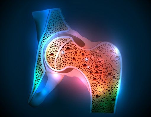 Mengenal Osteoporosis Sekunder