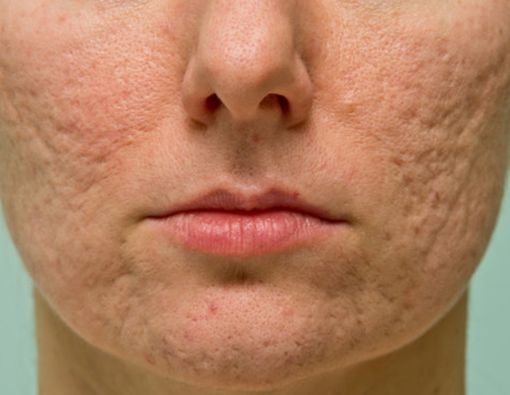 6 Cara Ampuh Hilangkan Bopeng yang Mengganggu Penampilan