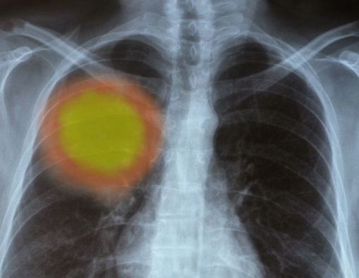 Komplikasi Kanker Paru yang Perlu Diketahui