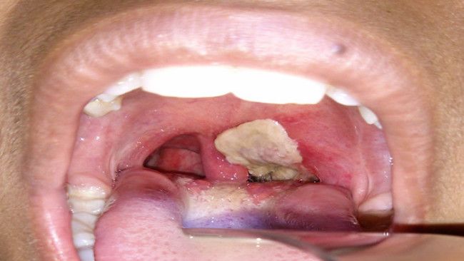 3 Komplikasi Difteri yang Perlu Anda Tahu