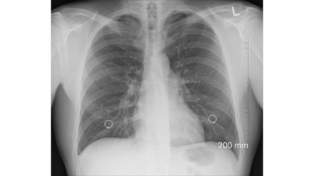 Patah Tulang Rusuk Bisa Picu Sesak Napas, Ini Penyebabnya