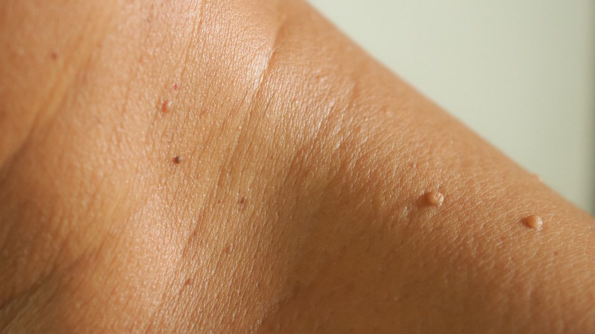 Muncul Benjolan di Leher, Hati-Hati Neck Tag!