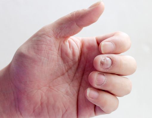 Kena Kutu Air di Tangan, Amankah Jika Berhubungan Seksual?