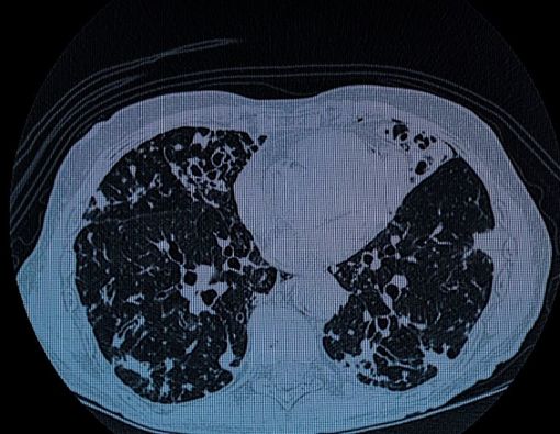 Faktor yang Meningkatkan Risiko Bronkiektasis