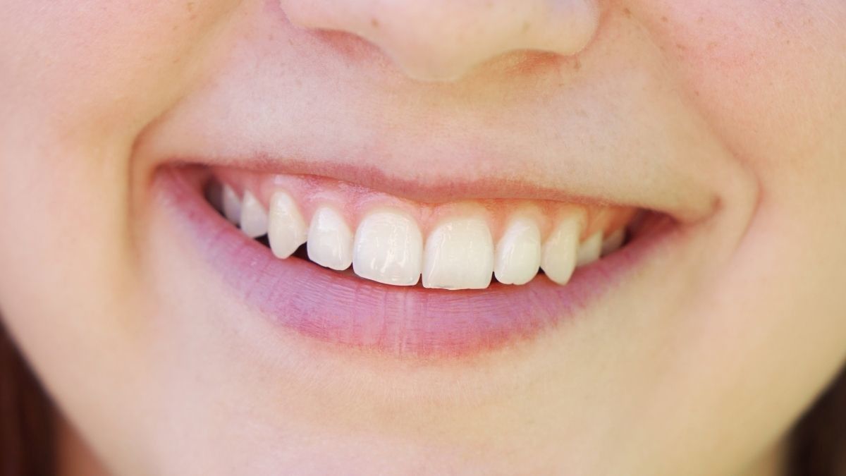 Muncul Bercak Putih di Gigi, Ini Penyebabnya