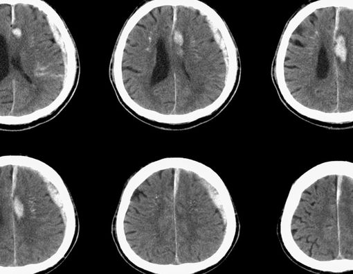 Mengenal Penyakit Hematoma Subdural, Perdarahan di Lapisan Otak