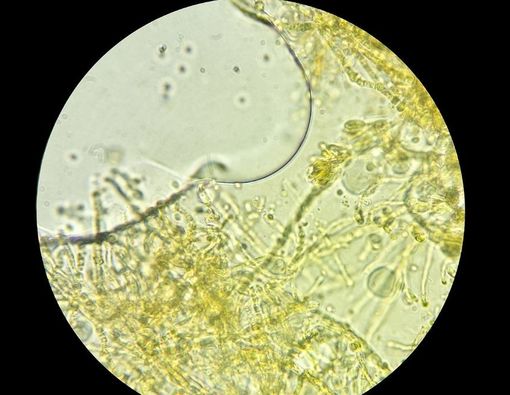 Kenali Infeksi Jamur Kuning yang Serang Pengidap COVID-19 di India