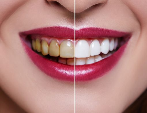 4 Mitos Tentang Veneer Gigi yang Harus Diluruskan