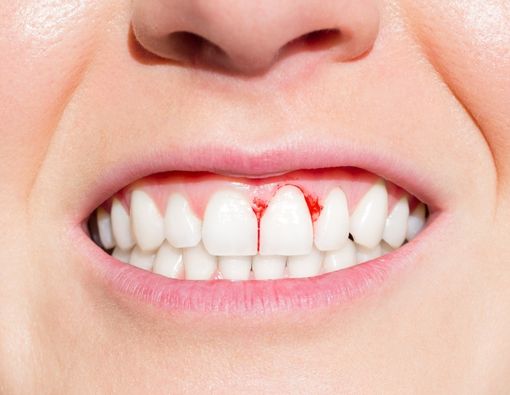 Ini Perbedaan Gingivitis dan Periodontitis