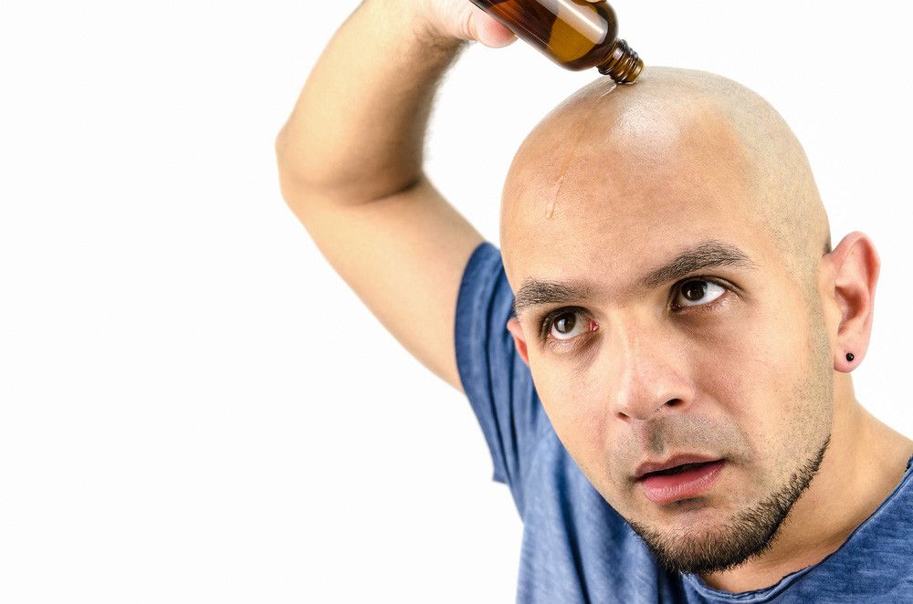5 Pilihan Terapi untuk Atasi Kebotakan pada Pria