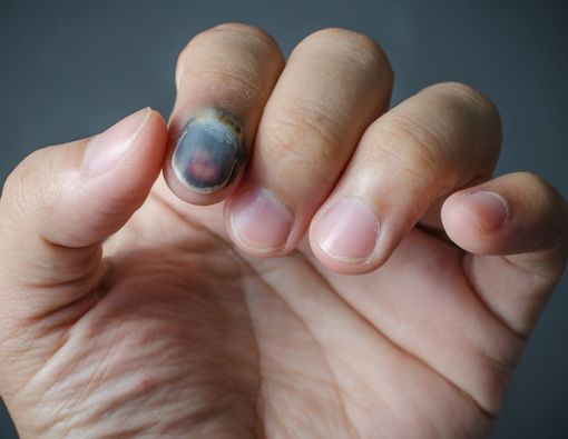 Kuku Jadi Biru karena Terjepit, Apa yang Harus Dilakukan?