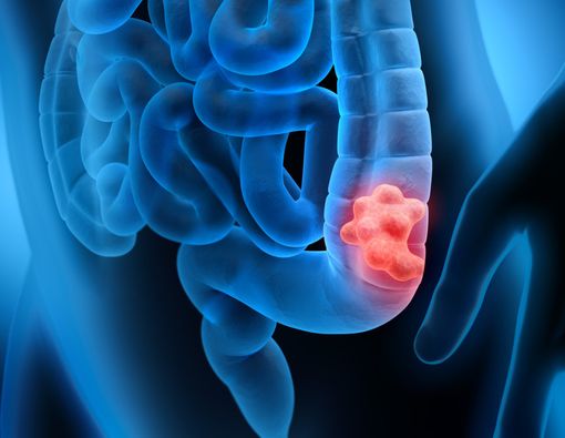 Polip Usus Berubah Jadi Kanker, Butuh Waktu Berapa Lama?